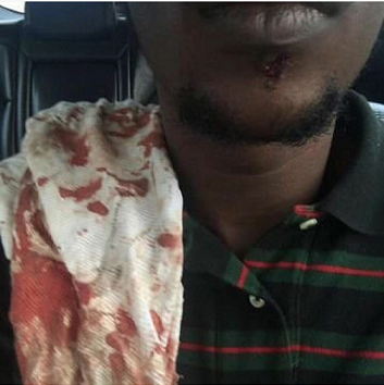 Trending: Picture of Dammy Krane Bleeding Emerges