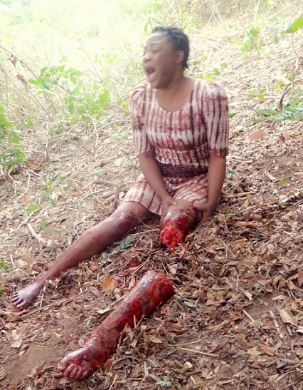 How Popular Actress Lost Leg In An Accident (Graphic Photo)